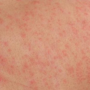 Alergije na koži se manifestiraju u obliku crvenila i osipa - dermatitis i urtikarija